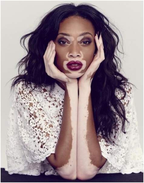 Melanocyte Transplantation in Vitiligo – The Science Behind and Rates of Success
