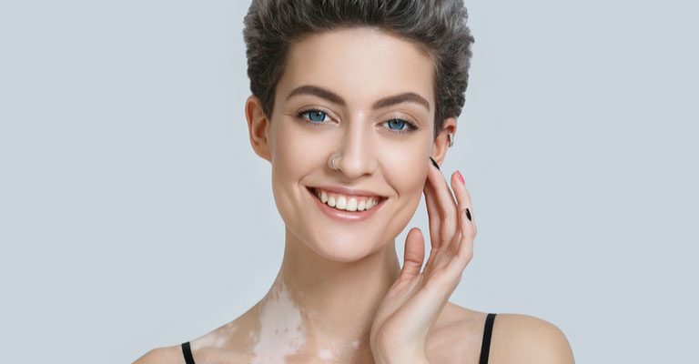 Vitiligo Graffting - How Effecting is it ?