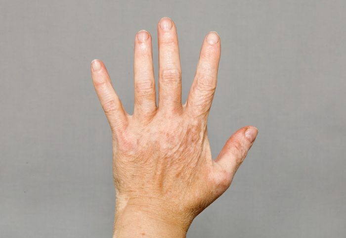 Inspiration for People with Vitiligo.