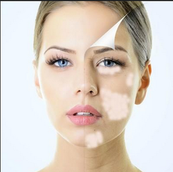 Introduction to vitiligo surgical treatment
