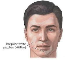 Melanocyte Tranplantation: A New Way to Treat Vitiligo