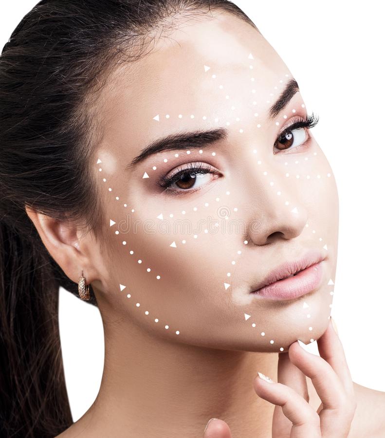 New Vitiligo Therapies and Treatments